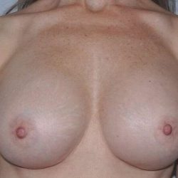 Breast Implant Revision Before & After Patient #1216