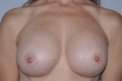 Breast Implant Revision Before & After Patient #1216