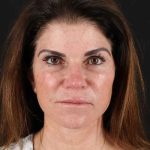 All Me Facelift Before & After Patient #406