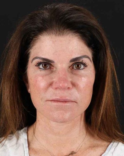 All Me Facelift Before & After Patient #406