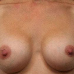 Breast Augmentation Before & After Patient #1246