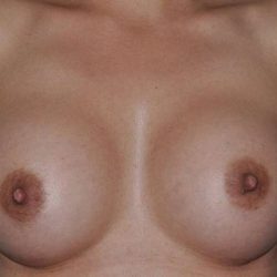 Breast Augmentation Before & After Patient #1251