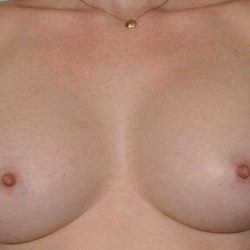 Breast Augmentation Before & After Patient #1266