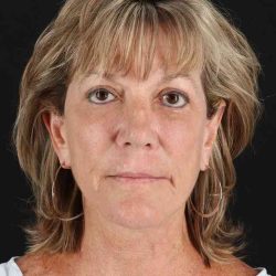 All Me Facelift Before & After Patient #418