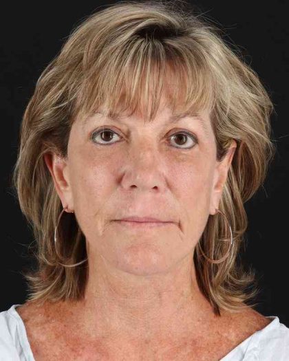 All Me Facelift Before & After Patient #418