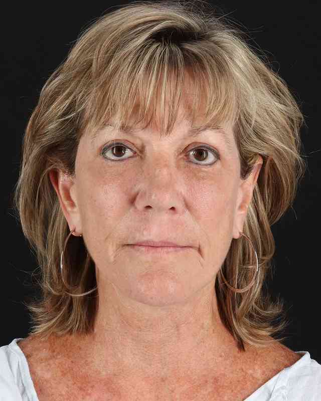 All Me Facelift Before & After Patient #418
