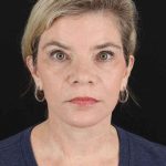 All Me Facelift Before & After Patient #428