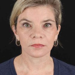 All Me Facelift Before & After Patient #428