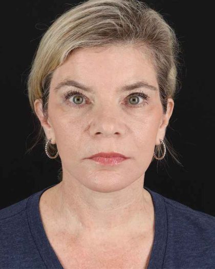 All Me Facelift Before & After Patient #428