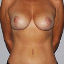Mommy Makeover Before & After Patient #1398