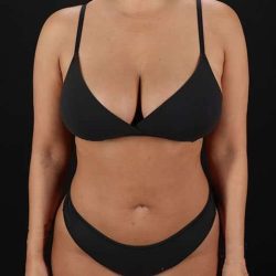 Liposuction Before & After Patient #1422