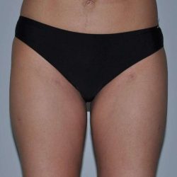 Liposuction Before & After Patient #1427