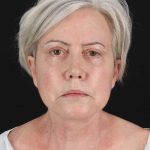 All Me Facelift Before & After Patient #439
