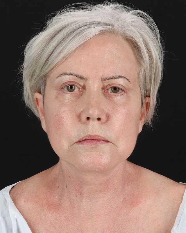 All Me Facelift Before & After Patient #439