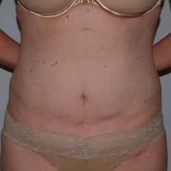 Liposuction Before & After Patient #1437