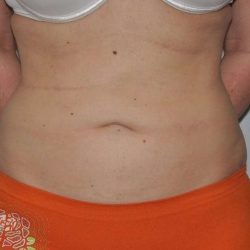 Liposuction Before & After Patient #1442