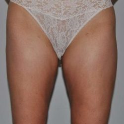 Liposuction Before & After Patient #1447