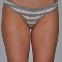 Liposuction Before & After Patient #1450