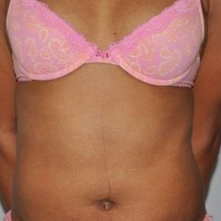 Liposuction Before & After Patient #1455