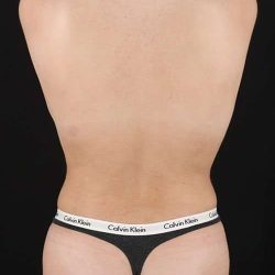 Liposuction Before & After Patient #1463