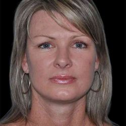 All Me Facelift Before & After Patient #252