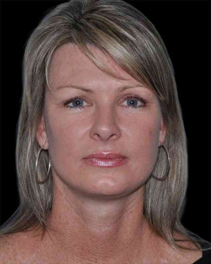 All Me Facelift Before & After Patient #252