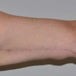 Brachioplasty (Arm Lift) Before & After Patient #1481
