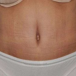 Abdominoplasty (Tummy Tuck) Before & After Patient #1495