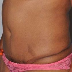 Abdominoplasty (Tummy Tuck) Before & After Patient #1502