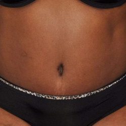 Abdominoplasty (Tummy Tuck) Before & After Patient #1509