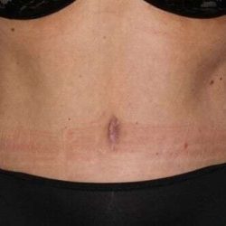 Abdominoplasty (Tummy Tuck) Before & After Patient #1523