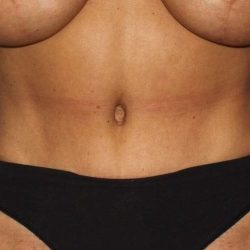 Abdominoplasty (Tummy Tuck) Before & After Patient #1530