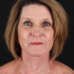 All Me Facelift Before & After Patient #461