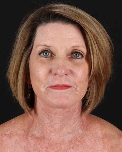 All Me Facelift Before & After Patient #461