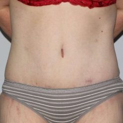 Abdominoplasty (Tummy Tuck) Before & After Patient #1544