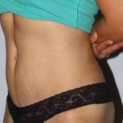 Abdominoplasty (Tummy Tuck) Before & After Patient #1549