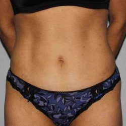 Abdominoplasty (Tummy Tuck) Before & After Patient #1556