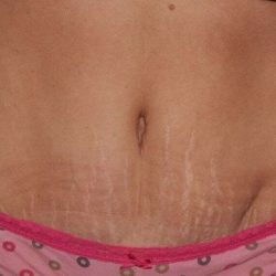 Abdominoplasty (Tummy Tuck) Before & After Patient #1563