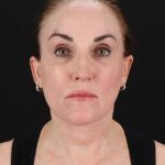 All Me Facelift Before & After Patient #472