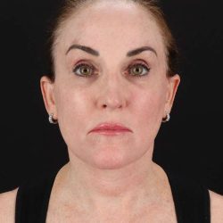 All Me Facelift Before & After Patient #472