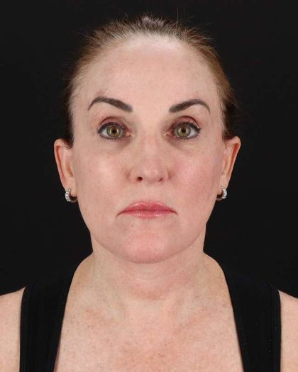 All Me Facelift Before & After Patient #472