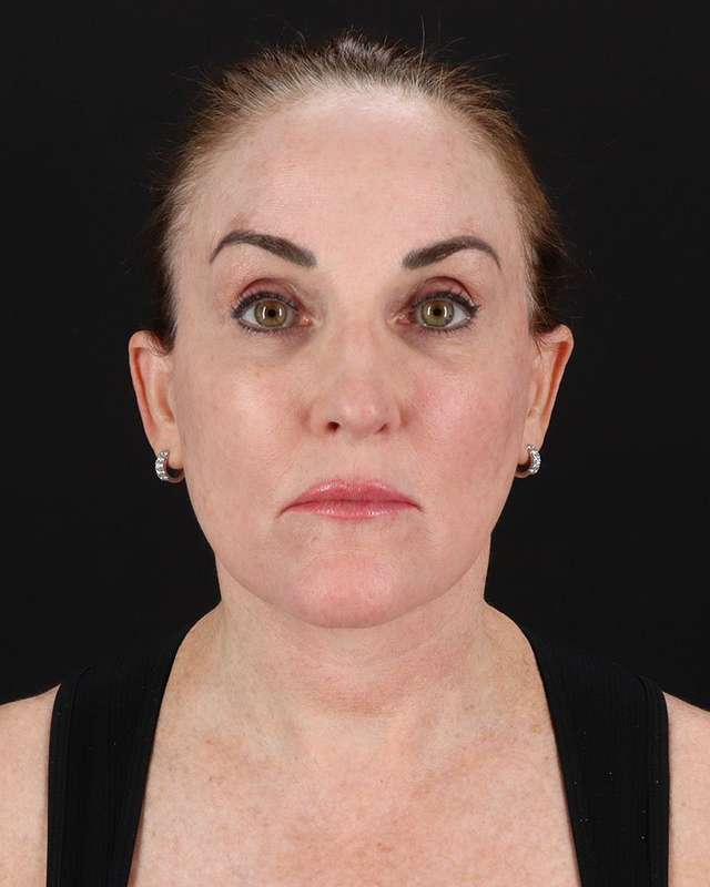 All Me Facelift Before & After Patient #472