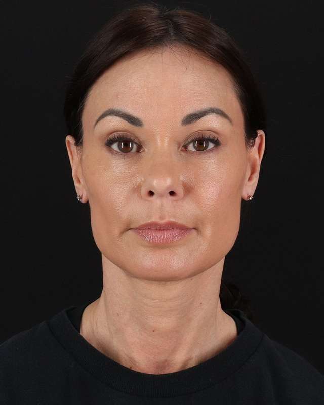 All Me Facelift Before & After Patient #483