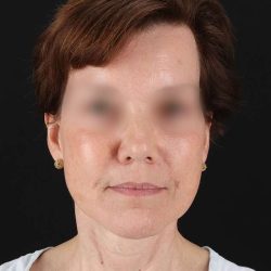 All Me Facelift Before & After Patient #229