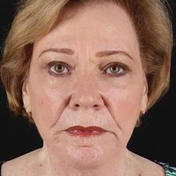 Neck Lift Before & After Patient #508