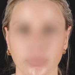 Otoplasty Before & After Patient #513