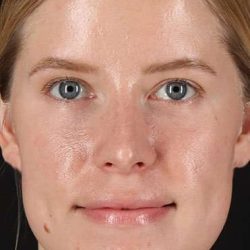 Rhinoplasty Before & After Patient #524