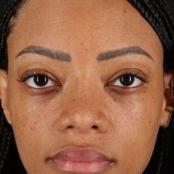 Rhinoplasty Before & After Patient #535