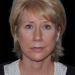 All Me Facelift Before & After Patient #263