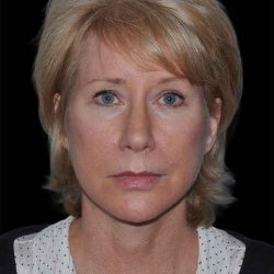 All Me Facelift Before & After Patient #263